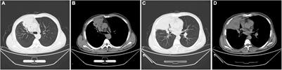 Pulmonary Actinomyces graevenitzii Infection: Case Report and Review of the Literature